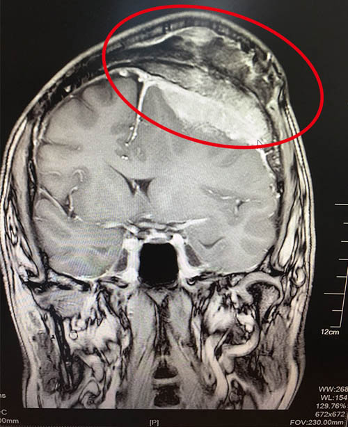 ��Ĥ��������Ҫע������������