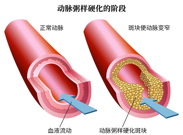 动脉粥样硬化是引起颈动脉狭窄的最常见原因