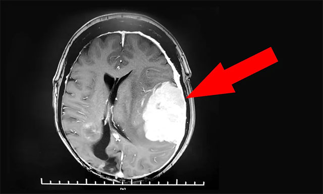 患者左侧颞顶叶巨大占位