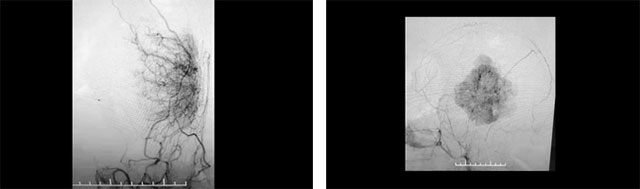 肿瘤病灶血供丰富