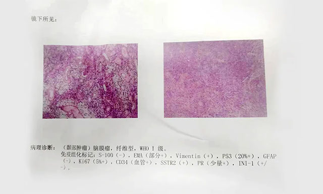 “元凶”为脑膜瘤