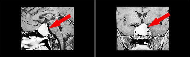 肿瘤侵袭生长,包绕颈内动脉,knosp分级IV级