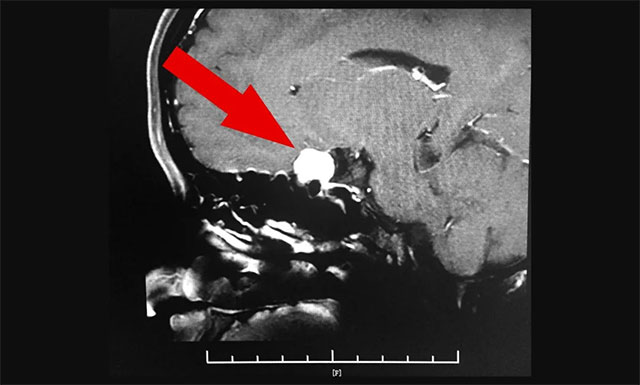 脑膜瘤已压迫患者左侧视神经,需及时手术治疗