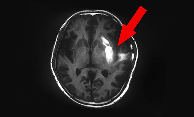 脑出血部位临近功能区,致使患者右侧肢体偏