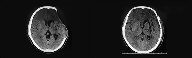 颅骨修补前(左)后(右)